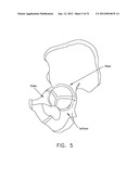 METHOD AND APPARATUS FOR ACCESSING THE INTERIOR OF A HIP JOINT, INCLUDING     THE PROVISION AND USE OF A NOVEL INFLOW ACCESS CANNULA diagram and image