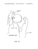 METHOD AND APPARATUS FOR ACCESSING THE INTERIOR OF A HIP JOINT, INCLUDING     THE PROVISION AND USE OF A NOVEL INFLOW ACCESS CANNULA diagram and image