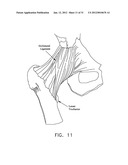 METHOD AND APPARATUS FOR ACCESSING THE INTERIOR OF A HIP JOINT, INCLUDING     THE PROVISION AND USE OF A NOVEL INFLOW ACCESS CANNULA diagram and image