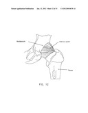 METHOD AND APPARATUS FOR ACCESSING THE INTERIOR OF A HIP JOINT, INCLUDING     THE PROVISION AND USE OF A NOVEL INFLOW ACCESS CANNULA diagram and image