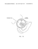 METHOD AND APPARATUS FOR ACCESSING THE INTERIOR OF A HIP JOINT, INCLUDING     THE PROVISION AND USE OF A NOVEL INFLOW ACCESS CANNULA diagram and image