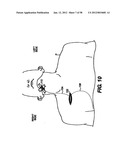 Obstructive Sleep Apnea Treatment Devices, Systems and Methods diagram and image