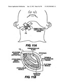 Obstructive Sleep Apnea Treatment Devices, Systems and Methods diagram and image