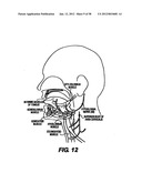 Obstructive Sleep Apnea Treatment Devices, Systems and Methods diagram and image