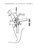 Obstructive Sleep Apnea Treatment Devices, Systems and Methods diagram and image