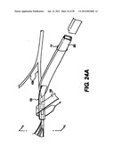 Obstructive Sleep Apnea Treatment Devices, Systems and Methods diagram and image