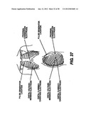 Obstructive Sleep Apnea Treatment Devices, Systems and Methods diagram and image