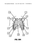 Obstructive Sleep Apnea Treatment Devices, Systems and Methods diagram and image