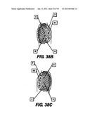 Obstructive Sleep Apnea Treatment Devices, Systems and Methods diagram and image