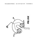 Obstructive Sleep Apnea Treatment Devices, Systems and Methods diagram and image