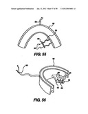 Obstructive Sleep Apnea Treatment Devices, Systems and Methods diagram and image