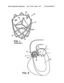 METHOD AND APPARATUS FOR PROSTHETIC VALVE REMOVAL diagram and image