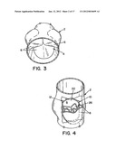 METHOD AND APPARATUS FOR PROSTHETIC VALVE REMOVAL diagram and image