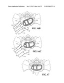 SPINAL IMPLANT FOR USE DURING RETROPERITONEAL LATERAL INSERTION PROCEDURES diagram and image