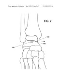 PARTIAL ANKLE JOINT REPLACEMENT IMPLANT diagram and image