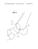 PARTIAL ANKLE JOINT REPLACEMENT IMPLANT diagram and image