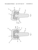 PROSTHETIC IMPLANT AND ASSEMBLY METHOD diagram and image