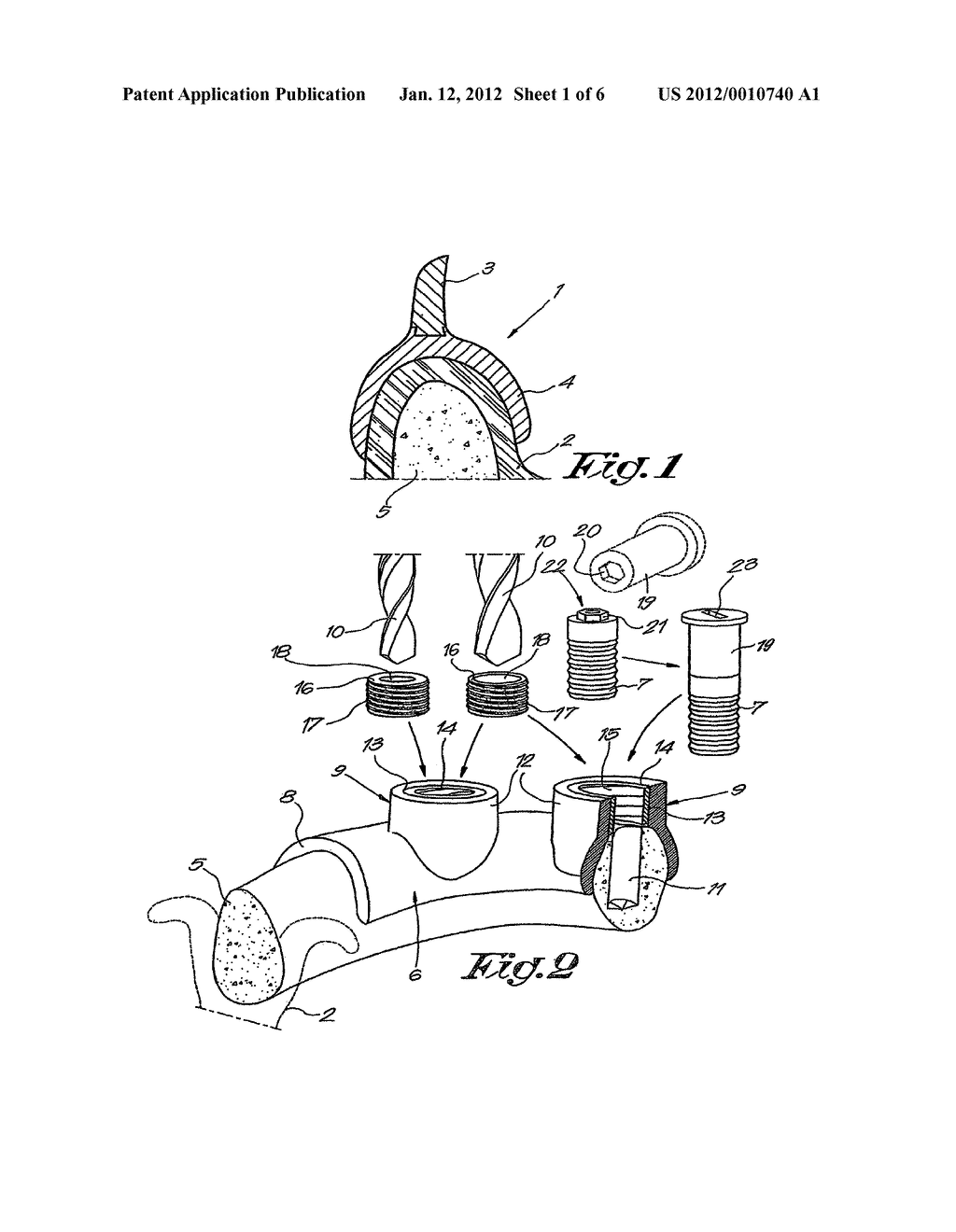 METHOD FOR PLACING AND MANUFACTURING A DENTAL SUPERSTRUCTURE, METHOD FOR     PLACING IMPLANTS AND ACCESSORIES USED THEREBY - diagram, schematic, and image 02