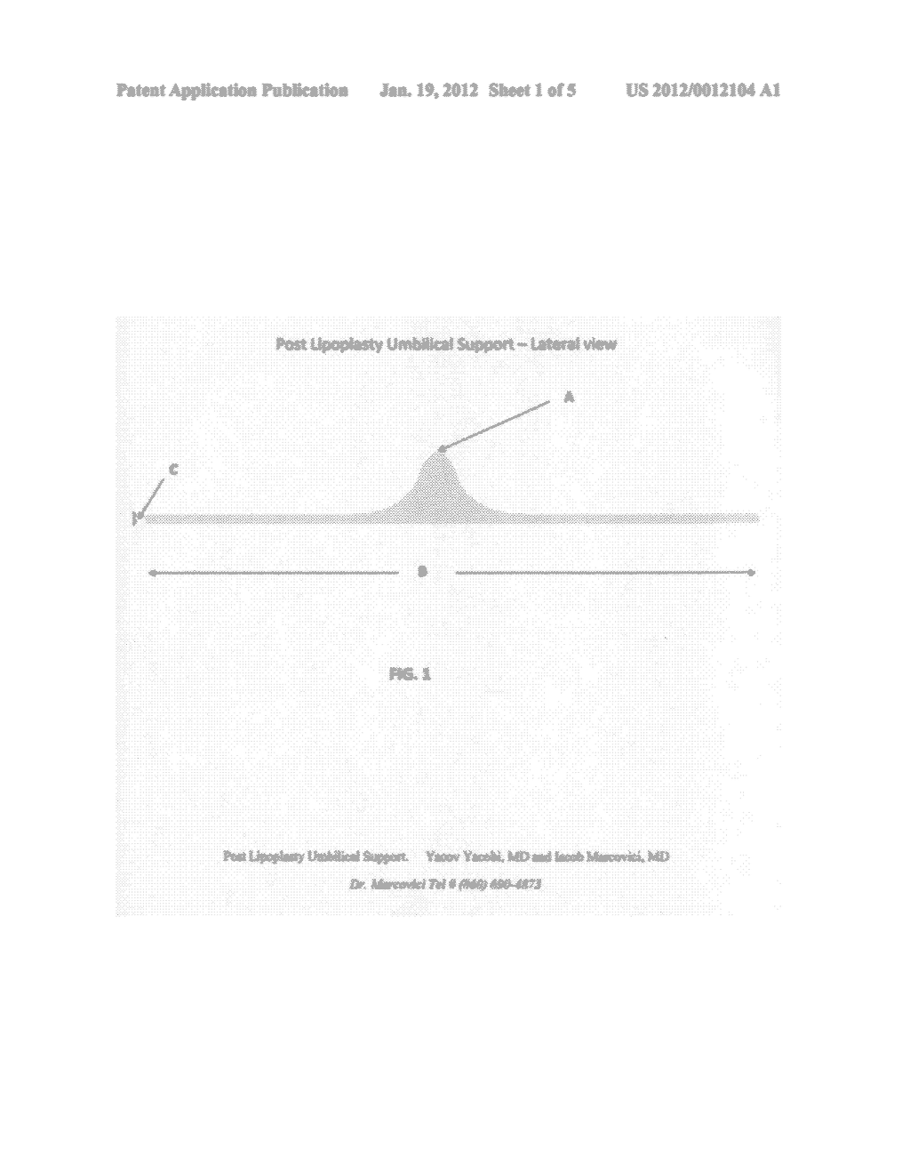 Post lipoplasty imbilical support - diagram, schematic, and image 02