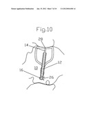 MIDDLE EAR IMPLANT diagram and image