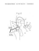 MIDDLE EAR IMPLANT diagram and image