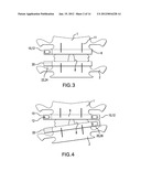 SYSTEM, APPARATUS, AND METHOD FOR IN-VIVO ASSESSMENT OF RELATIVE POSITION     OF AN IMPLANT diagram and image