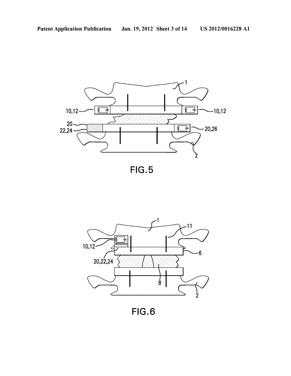 SYSTEM, APPARATUS, AND METHOD FOR IN-VIVO ASSESSMENT OF RELATIVE POSITION     OF AN IMPLANT - diagram, schematic, and image 04