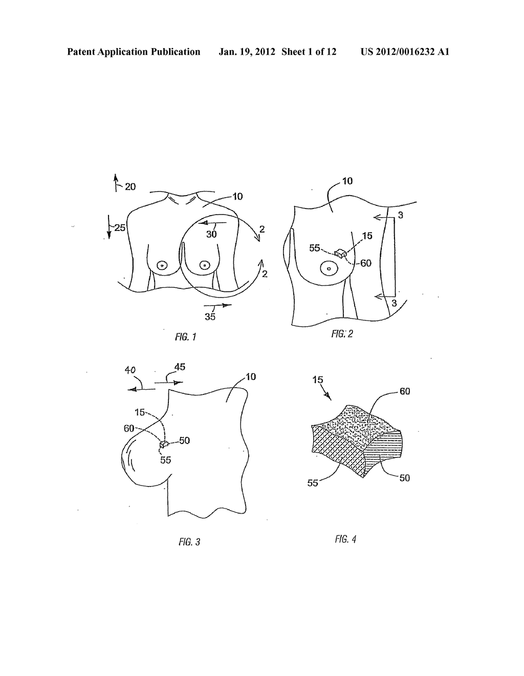 SURGICAL SYSTEM WITH CLIPS FOR IDENTIFYING THE ORIENTATION OF A TISSUE     SAMPLE - diagram, schematic, and image 02