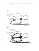 ABDOMINAL CIRCULATORY PUMP DEVICE diagram and image