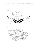 ABDOMINAL CIRCULATORY PUMP DEVICE diagram and image