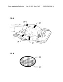 ABDOMINAL CIRCULATORY PUMP DEVICE diagram and image