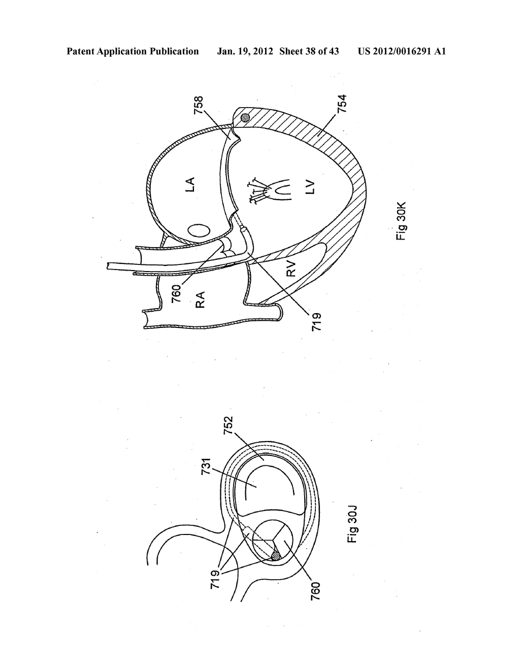 ROBOTICALLY CONTROLLED INTRAVASCULAR TISSUE INJECTION SYSTEM - diagram, schematic, and image 39