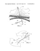 PEG TUBE WITH WIRELESS PULL TIP diagram and image