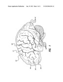 TREATMENT OF MOOD AND/OR ANXIETY DISORDERS BY ELECTRICAL BRAIN STIMULATION     AND/OR DRUG INFUSION diagram and image