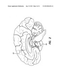 TREATMENT OF MOOD AND/OR ANXIETY DISORDERS BY ELECTRICAL BRAIN STIMULATION     AND/OR DRUG INFUSION diagram and image