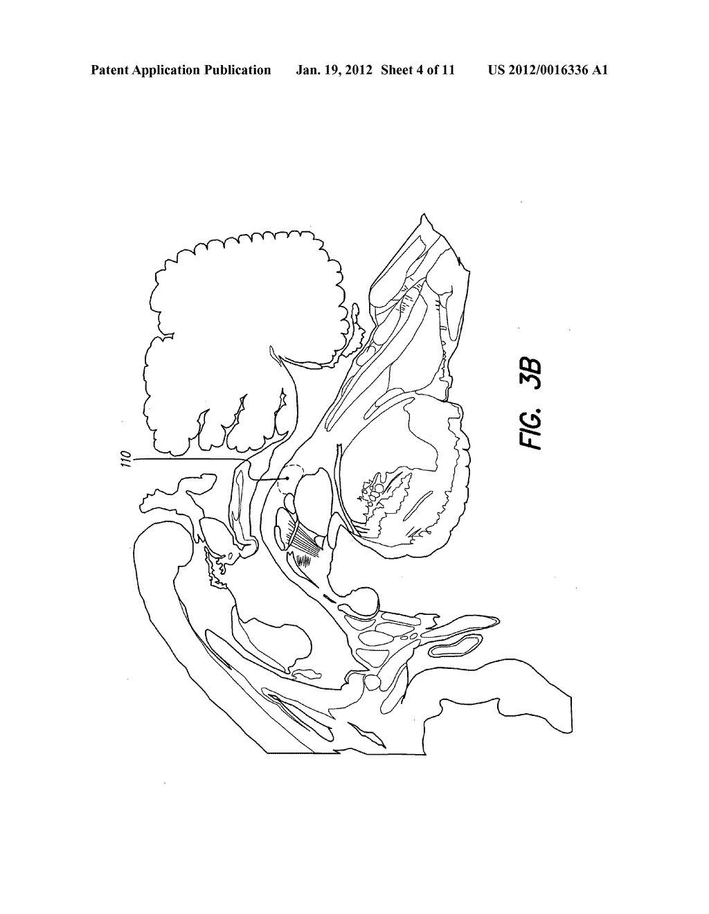 TREATMENT OF MOOD AND/OR ANXIETY DISORDERS BY ELECTRICAL BRAIN STIMULATION     AND/OR DRUG INFUSION - diagram, schematic, and image 05