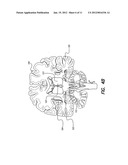 TREATMENT OF MOOD AND/OR ANXIETY DISORDERS BY ELECTRICAL BRAIN STIMULATION     AND/OR DRUG INFUSION diagram and image