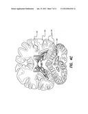 TREATMENT OF MOOD AND/OR ANXIETY DISORDERS BY ELECTRICAL BRAIN STIMULATION     AND/OR DRUG INFUSION diagram and image