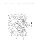 TREATMENT OF MOOD AND/OR ANXIETY DISORDERS BY ELECTRICAL BRAIN STIMULATION     AND/OR DRUG INFUSION diagram and image