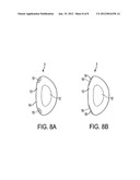 LENTICULAR REFRACTIVE SURGERY OF PRESBYOPIA, OTHER REFRACTIVE ERRORS, AND     CATARACT RETARDATION diagram and image