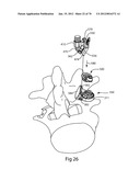 Facet Joint Replacement Instruments and Methods diagram and image