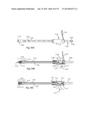 Facet Joint Replacement Instruments and Methods diagram and image