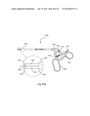 Facet Joint Replacement Instruments and Methods diagram and image