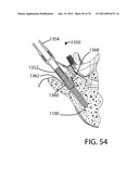 Facet Joint Replacement Instruments and Methods diagram and image