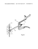 Facet Joint Replacement Instruments and Methods diagram and image