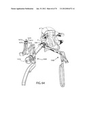 Facet Joint Replacement Instruments and Methods diagram and image