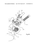 Facet Joint Replacement Instruments and Methods diagram and image