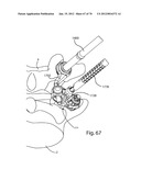 Facet Joint Replacement Instruments and Methods diagram and image