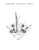 Facet Joint Replacement Instruments and Methods diagram and image