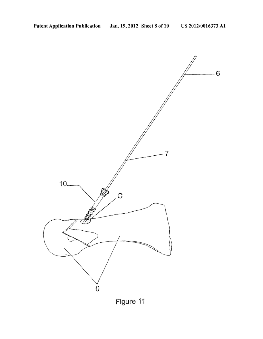 DEVICE TO ASSIST WITH THE PLACEMENT OF SCREWS IN BONE TISSUE AND     INSTRUMENT APPLYING SAID DEVICE, IN PARTICULAR FOR PERFORMING     OSTEOSYNTHESIS OF BONE FRAGMENTS - diagram, schematic, and image 09